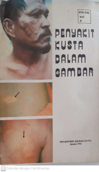 Penyakit Kusta dalam Gambar