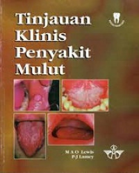 Tinjauan Klinis Penyakit Mulut