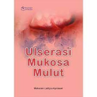 Ulserasi Mukosa Mulut