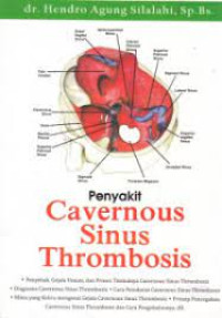 Penyakit Cavernous Sinus Thrombosis